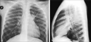 Infección por Mycoplasma que origina neumonía de tipo mixto en el lóbulo superior izquierdo. a) Rx AP, b) Rx lateral.