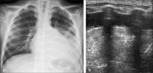 Derrame paraneumónico: Representación en Rx en posición de pies (a) y aspecto anecogénico al US (b).