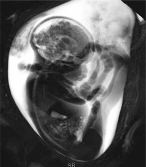 RM fetal, 33 semanas, volumen T2. Feto en presentación podálica. Las caderas están en flexión con las extremidades inferiores extendidas.
