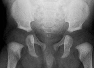 Pelvis radiológicamente normal. Los núcleos de osificación de las cabezas femorales no son visibles. Se reconocen sin embargo techos acetabulares con fosetas centrales, discretamente escleróticas, que permiten estimar la normal proyección de la cabeza femoral carilaginosa.