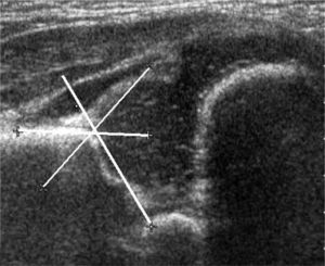 Ecografía de Cadera, método de Graf. Plano standard de análisis obtenido en mesa especial, en decúbito lateral y con la cadera con flexión de 30°. El ángulo alfa está formado por la línea horizontal del borde del íleon, con la línea del techo acetabular.
