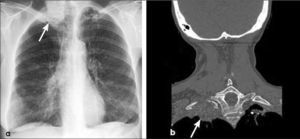 a, b: Tumor del vértice pulmonar. La radiografía frontal (a) muestra una asimetría de ambos vértices pulmonares con opacidad apical derecha sospechosa de neoplasia (flecha). Una TC con reconstrucción coronal confirma la lesión que se asocia con osteolisis de la primera costilla (flecha), hallazgo tomográfico específico de invasión de pared torácica. T3.