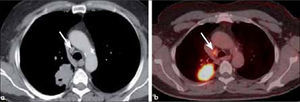a, b: Tumor de células escamosas excavado de 5.0 cm de diámetro (a) con adenopatía paratraqueal derecha baja (flecha en a y b). El PET-CT muestra actividad metabólica en ambas lesiones. T2a-N2.