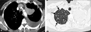 a, b: Adenocarcinoma del lóbulo superior izquierdo de 5.0 cm de diámetro con derrame pleural (a) y metástasis hematógenas en el pulmón contralateral (flechas en b). T2a-M1a.