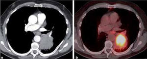 a, b: Tumor mayor de 7.0 cm de diámetro en lóbulo inferior izquierdo y de contornos discretamente irregulares, sugerente de carcinoma de células grandes (a). El PET-CT muestra significativa actividad metabólica glucídica del tumor (b).