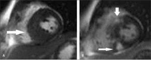 Imágenes de RM en eje corto que demuestran miocardiopatía hipertrófica septal asimétrica. A. Secuencia gradiente que demuestra la hipertrofia (flecha). B. Adquisición tardía post-gadolinio que demuestra focos de impregnación por fibrosis (flechas).