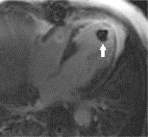 Adquisición tardía post-gadolinio en cuatro cámaras que demuestra infarto en territorio de arteria descendente anterior con impregnación transmural y adelgazamiento, y trombo apical (flecha).