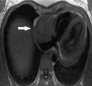 Corte axial que demuestra masa que compromete la pared de la aurícula derecha, de base ancha (flecha), que posteriormente se confirmó correspondía a angiosarcoma, el tumor maligno primario más frecuente en adultos.
