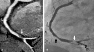 Placas no calcificadas en arteria coronaria derecha en TC (A) y angiografía convencional correspondiente (B) produciendo estenosis moderada (flecha negra) y severa (flecha blanca).