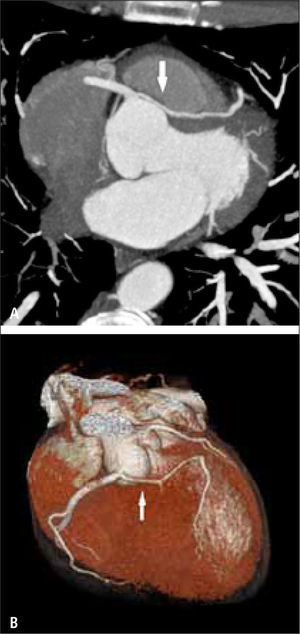Origen anómalo de la arteria coronaria iz-quierda a partir de la arteria coronaria derecha, con curso interarterial, lo que constituye curso “maligno” por la compresión de la arteria, en proyección de máxima intensidad (A) y volumétrica (B).