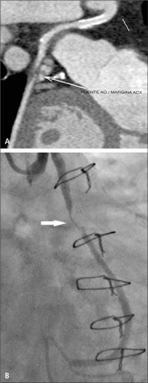 Stent permable y placa no calcificada (flechas) que produce estenosis significativa en puente de aorta a rama marginal de arteria circunfleja, visualizado en TC (A) y angiografía convencional (B).