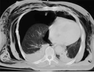 TC de tórax ventana pulmonar, que muestra neumotórax derecho a tensión con desviación del mediastino a la izquierda y enfisema de partes blandas.