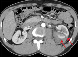 TC de abdomen con contraste. Se observa una laceración renal izquierda que compromete la corteza y medula renal sin extensión al sistema colector y con un hematoma perirrenal asociado (lesión grado III).