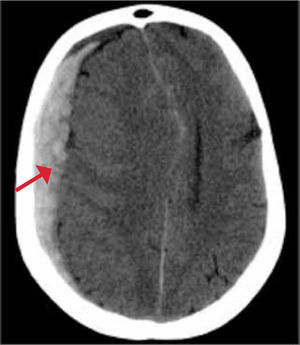 TC cerebro sin contraste corte axial hematoma subdural agudo (flecha).
