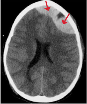 TC cerebro sin contraste corte axial hematoma epidural.