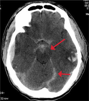 TC de cerebro sin contraste: Hemorragia subaracnoidea.
