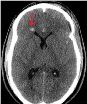 TC de cerebro sin contraste: Daño axonal difuso.