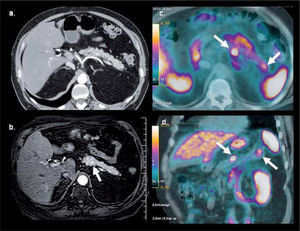 PET/CT con Ga68-DOTATATE en hombre de 64 años con gastrinemias elevadas. La tomografía computada (a) y resonancia magnética (b) muestran una sutil lesión hipervascular sospechosa en cuerpo pancreático. PET/ CT (c, d) confirma nódulo de alta captación en cuerpo pancreático y otro más pequeño en la cola, no visible con TC ni RM. La histología confrma gastrinoma de 8 mm en cuerpo y de 4 mm en cola.