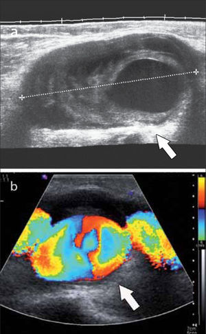 Paciente referido para estudio de masa poplítea, por sospecha de quiste de Baker. El US muestra (flecha): a) lesión solido-quística compleja, b) con Doppler Color se demuestra que corresponde a un Pseudoaneurisma poplíteo complicado.