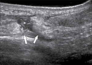 Tendón de Aquiles, eje largo: rotura completa en tercio medio (asterisco) con retracción de cabos tendíneos (flechas).