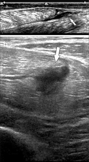Desgarros musculares (flecha): a) miofascial, b) fascicular, en el espesor del vientre muscular.
