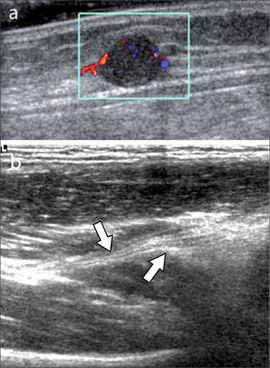 a) Tumor de nervio periférico, b) Cambio de calibre de nervio (flechas) en correlación con neuropatía por atrapamiento.