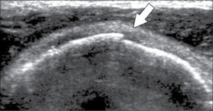 US de hombro en paciente con dolor post traumático, radiografía negativa para fractura: se evidencia resalte cortical (flecha) compatible con fractura por avulsión no desplazada de tuberosidad mayor del húmero.