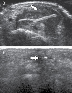 Cuerpo extraño (flecha): a) espina vegetal con tenosinovitis asociada, b) vidrio pequeño en el plano subcutáneo.