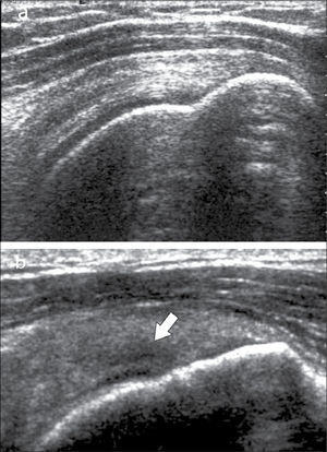 Tendón supraespinoso, eje largo: a) normal, b) foco de tendinosis (flecha).