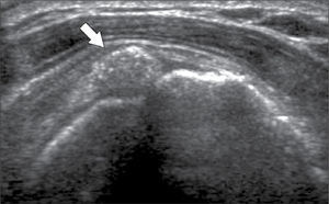 Tendinopatía cálcica del manguito rotador: calcificación en tendón supraespinoso que se proyecta a la bursa subacromiodeltoidea (flecha).