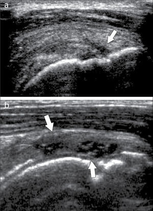 Rotura en tendón del manguito rotador (flechas): a) de espesor parcial, b) de espesor completo.
