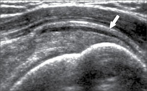 Bursitis subacromiodeltoidea: engrosamiento de su pared y líquido (flecha).