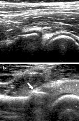 Articulación radiohumeral por anterior: a) normal, b) fractura oculta a radiografía en cabeza del radio (flecha), con derrame articular ecogénico posiblemente hemático (asterisco).