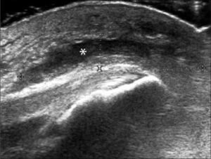 Bursitis olecraneana (asterisco): colección líquida, engrosamiento y compromiso edematoso de partes blandas en cara posterior del codo, superficial al tendón del tríceps.