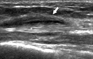 Tendón extensor, eje largo (asterisco): tenosinovitis con engrosamiento y líquido en la vaina tendínea (flecha).