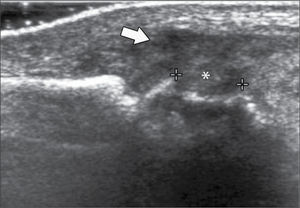 Engrosamiento sinovial metacarpofalángico (flecha) y erosión (asterisco) en paciente con Artritis Reumatoide.