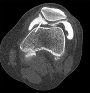 Artro TAC de rodilla. Medio de contraste distendiendo la cápsula. Lesión condral tipo flap en el cartílago rotuliano de la faceta medial