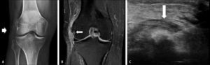 A: Rx de rodilla que muestra calcificaciones en ligamento colateral lateral (flecha). B: RM de rodilla que muestra además del calcio, el proceso inflamatorio agudo (flecha). C: Punción y aspiración del contenido cálcico bajo visión ecográfica (flecha).