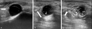 A: Imagen ecográfica de ganglion por detrás del maléolo tibial posterior (flecha). B: Punción y evacuación del contenido bajo visión ecográfica (flecha). C: Infiltración con corticoides de la cavidad residual (flecha).