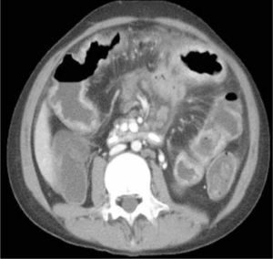 ETC, corte axial. Enfermedad de Crohn. Extenso engrosamiento parietal de yeyuno asociado a adenopatías mesentéricas y microabsceso en aspecto anterior del mesenterio.