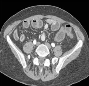 ETC, corte axial. Carcinoide multifocal de íleon. Se observan nódulos hipervasculares en la pared del íleon asociados a adenopatías hipervasculares lobuladas mesentéricas.