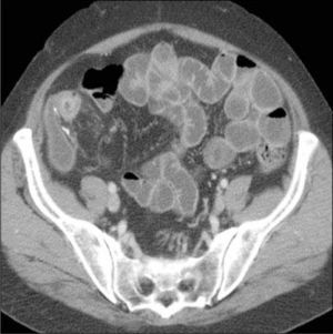 ETC, corte axial. Enfermedad de Crohn. Ileitis distal asociado a proliferación del tejido adiposo en fosa ilíaca derecha.
