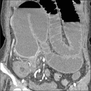 ETC, reformateo coronal. Enfermedad de Crohn. Obstrucción parcial de íleon distal con dilatación de asas hacia proximal.