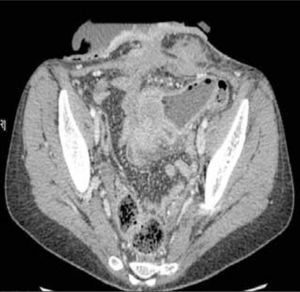 ETC, corte axial. Enfermedad de Crohn. Fístula entero-cutánea asociada a masa inflamatoria mesentérica.