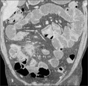ETC, reformateo coronal. Enfermedad de Crohn. Engrosamiento parietal de íleon asociado a proceso inflamatorio flegmonoso en fosa ilíaca derecha.