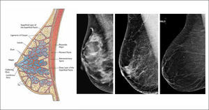 Dibujo de mama y diferentes patrones de densidad mamaria en mamografía