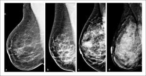 Clasificación bi-rads acr. patrones de densidad mamográfica a- Predominantemente adiposa, b- Densidades fibroglandulares dispersas, c- Heterogéneamente densa y d- Extremadamente densa.