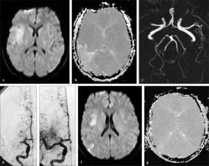 Trombolisis Cerebral Intra-arterial. (a) RM - secuencia de Difusión (DWI), muestra aumento de señal en región silviana profunda derecha compatible con infarto cerebral agudo. (b) RM - secuencia de Perfusión (PWI) muestra una gran area de baja irrigación (hipoperfusión) en el territorio silviano posterior derecho. (c) AngioResonancia Cerebral, muestra una completa oclusión de la arteria cerebral media derecha proximal. (d) Angiografia cerebral digital muestra también una completa oclusión de la arteria cerebral media derecha proximal y una satisfactoria recanalización posterior a una terapia endovascular (e). (f) Control RM DWI no muestra aumento de tamaño de infarto cerebral. (g) Control RM PWI muestra una normalización de la perfusión cerebral en el territorio silviano derecho.