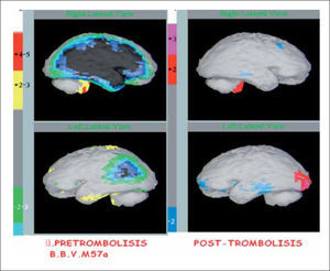 NeuroSPECT cerebral en AVE isquémico agudo. Muestra imágenes de NeuroSPECT cerebral antes y un control posterior a la trombolisis cerebral donde se observa una extensa hipoperfusión (color oscuro) cerebral bilateral mayor a derecha que luego de la trombolisis se revierte completamente (color gris). El paciente tuvo una excelente evolución.