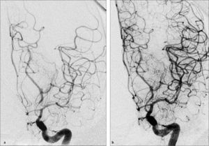 Angioplastia cerebral del vasoespasmo por hemorragia subaracnoidea. (a) Angiografia cerebral digital carotidea izquierda muestra un severo vasoespasmo de arteria cerebral media y cerebral posterior izquierda. (b) Angiografia cerebral luego de angioplastia cerebral farmacológica con Milrinona intra-arterial y angioplastia mecánica muestra un significativa mejoría en el calibre del los vasos de esta circulación.